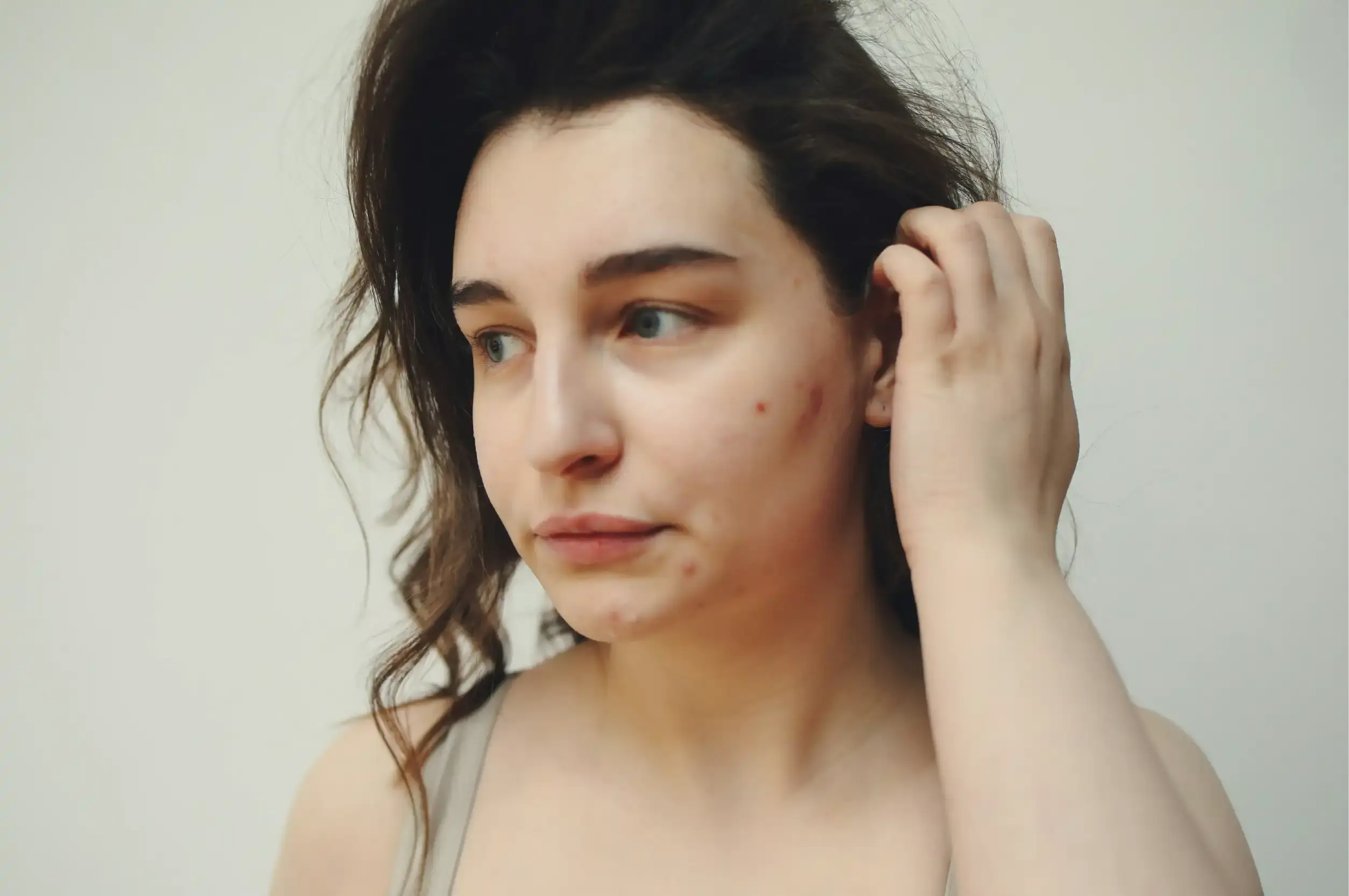 Acne & Blemish Control